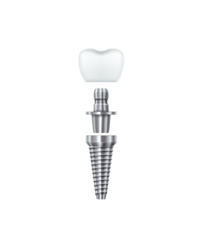 Aufbau eines Zahnimplantats: Krone, Abutment und Implantatkörper